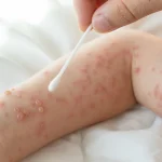 Varicella Zoster Virus Yang Menyebabkan Penyakit Cacar Air