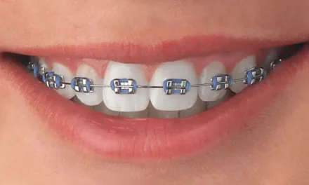 Kawat Gigi Atau Behel Untuk Merapikan Gigi